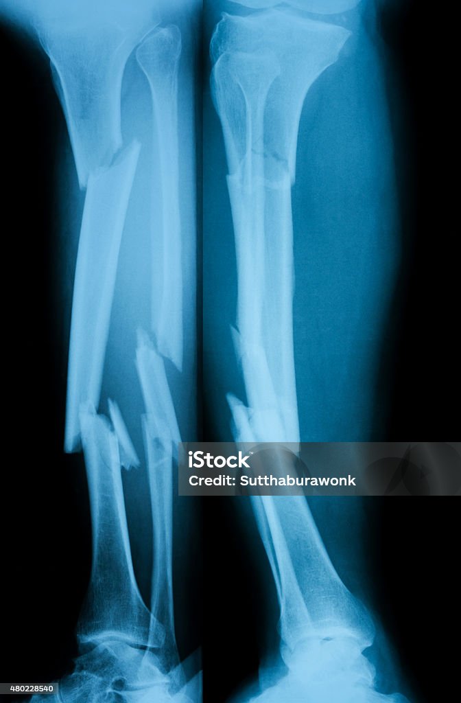 X-ray image of broken leg, AP view and lateral view. X-ray image of broken leg, AP view and lateral view. Showing tibia and fibula fractures. X-ray Image Stock Photo