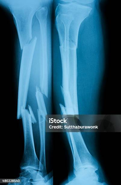 Xray Image Of Broken Leg Ap View And Lateral View Stock Photo - Download Image Now