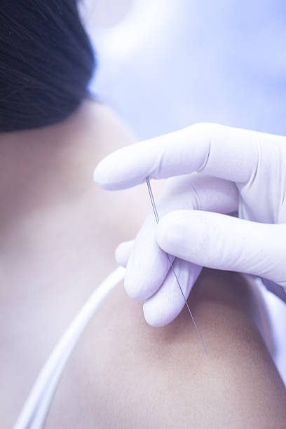 istock Doctor hand acupuncture needle dry needling 480243834