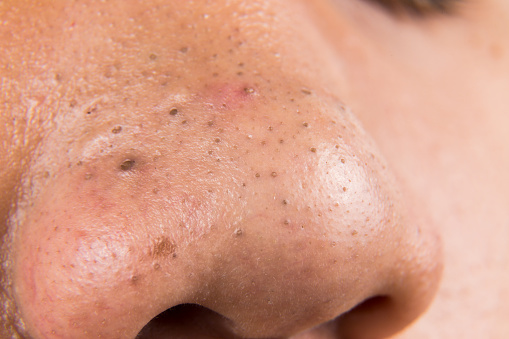 Ugly pimples, acne, zit, blackheads on the nose of teenager