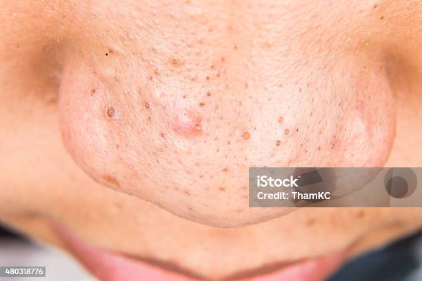 Ugly Pimples Acne Zit Blackheads On The Nose Of Teenager Stock Photo - Download Image Now