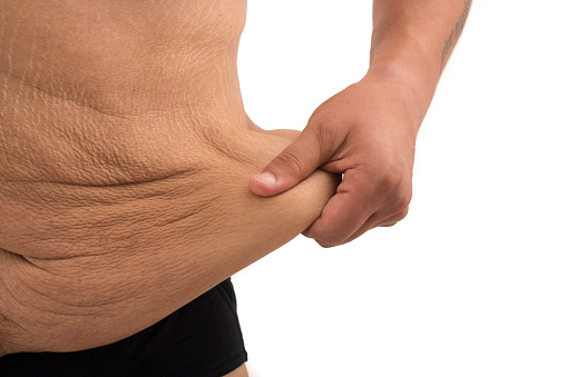 man with fat belly and stretch marks