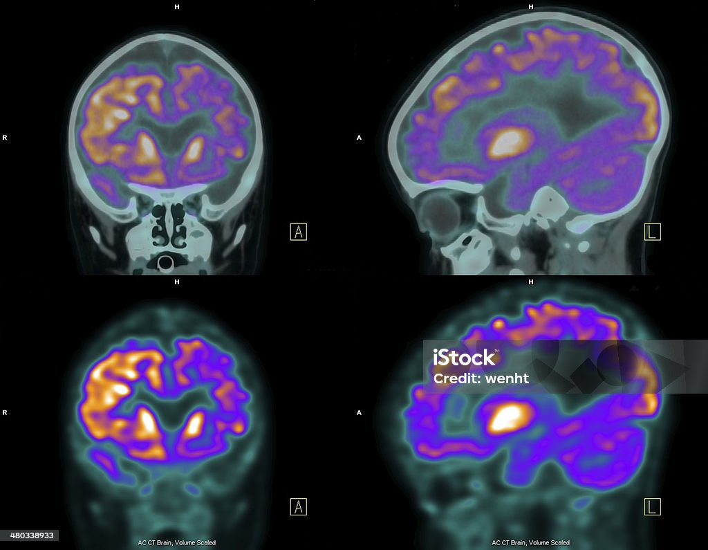 (positron emission tomography, PET) 스캔은 뇌 - 로열티 프리 PET 스캔 스톡 사진