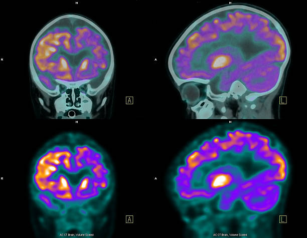 (positron emission tomography, pet) 스캔은 뇌 - 반구체 뉴스 사진 이미지