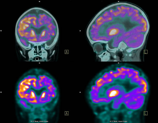 PET (positron emission tomography) scan of the brain These are computer generated images called PET (positron emission tomography) of the brain. It consists of injecting a radioactive analogue of glucose, FDG (fluorodeoxyglucose) into the bloodstream; the three- dimensional images of tracer concentration within the brain are then constructed by computer analysis. The more metabolically active areas will retain more FDG, and consequently retain more radioation (orange color). It is an important tool for detecting malignant tumors such as metastasis mainly in other parts of the body. In the brain, it also has been used to detect areas of the brain that generate seizures. metastasis photos stock pictures, royalty-free photos & images