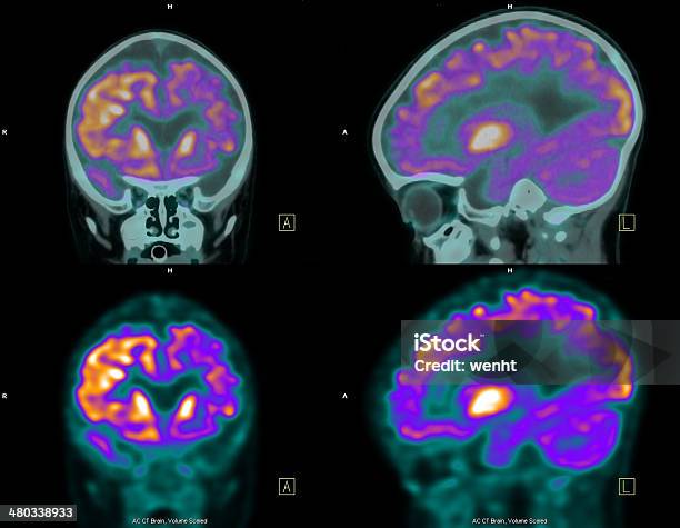 Por Tomografia De Emissão Positrão Tomografia Do Cérebro - Fotografias de stock e mais imagens de Tomografia por Emissão de Positrões