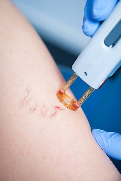 spider veins medical laser Treatment of spider veins with medical laser spider veins stock pictures, royalty-free photos & images