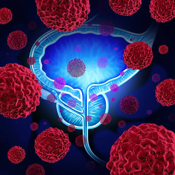 Prostate cancer danger medical concept as cancerous cells in a male body attacking the reproductive system as a symbol of human malignant tumor growth diagnosis treatment and risks.