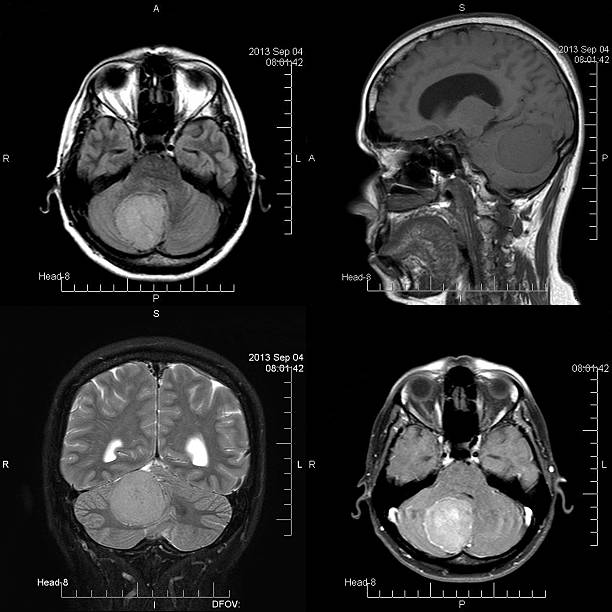 опухоль головного мозга - brain mri scanner mri scan medical scan стоковые фото и изображения