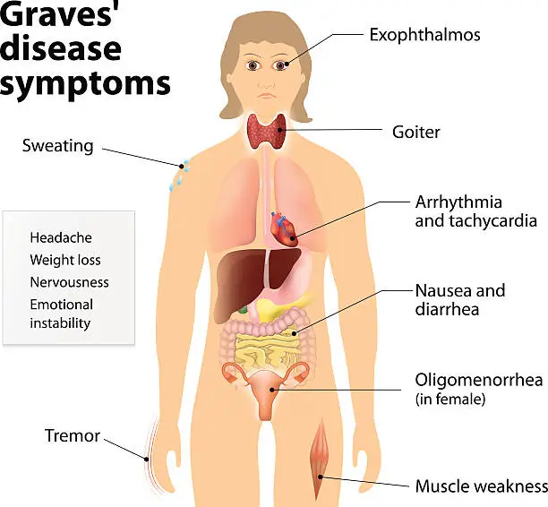 Vector illustration of Graves' disease or Basedow disease. Symptoms and signs