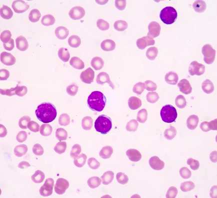 Blood cell formation from bone marrow.Acute lymphoblastic leukemia(ALL),fine with microscope(100x)