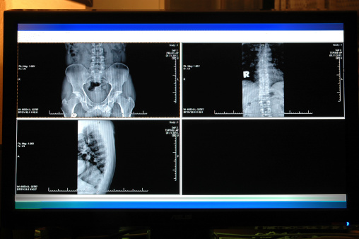 X ray images of pelvis a human body on the computer monitor