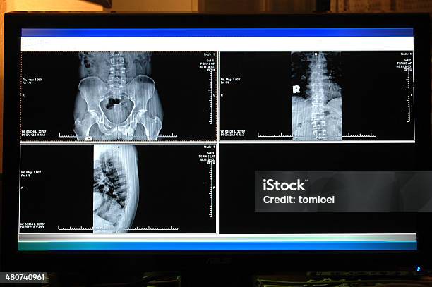 X Ray Of Pelvis Stock Photo - Download Image Now - Anatomy, Arthritis, Back