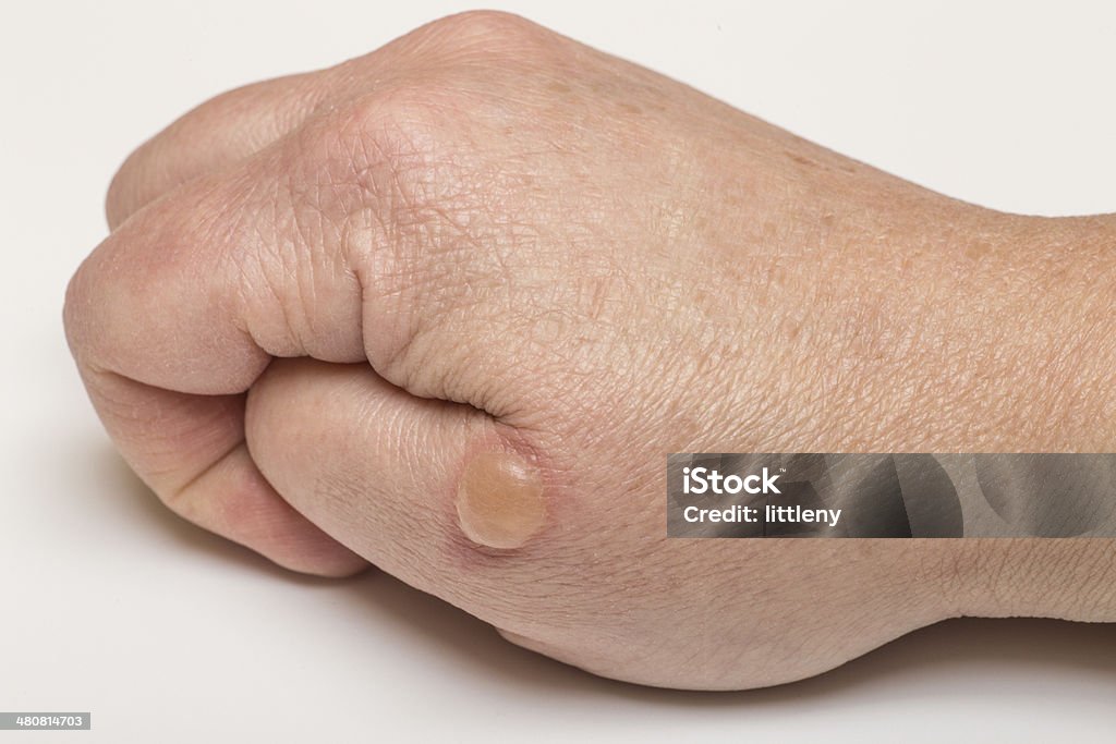 Blistered Skin Hand with blister from burn Blister Stock Photo