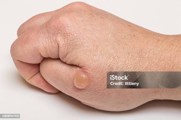 Blistered Skin Stock Photo - Download Image Now - Blister, Human Skin, Boiling