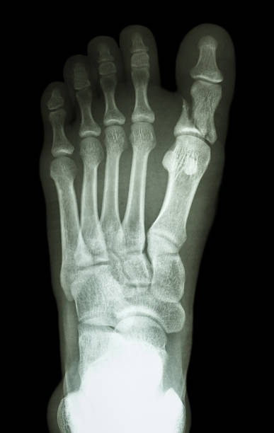 fracture proximal phalange at first toe film x-ray show fracture proximal phalange at first toe pollex stock pictures, royalty-free photos & images