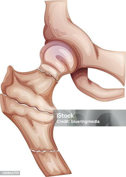 Переломы На — стоковая векторная графика и другие изображения на тему Анатомия - Анатомия, Бедренная кость, Болезнь
