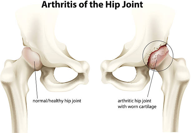 zapalenie stawów stawu biodrowego - biodro stock illustrations