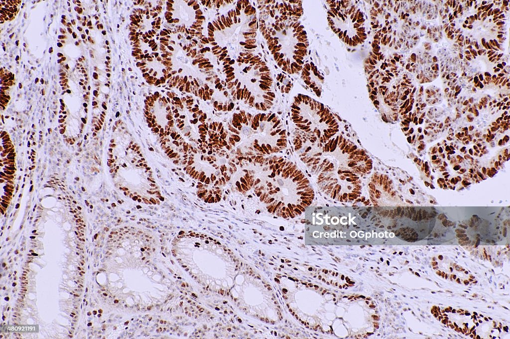 Bichinhos microscópicos imagem colon Câncer - Foto de stock de Câncer colorretal royalty-free