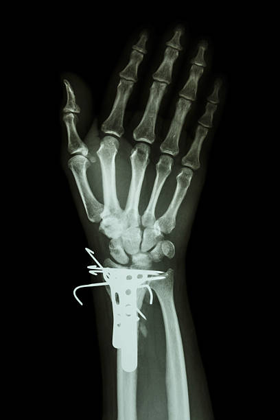 istock fracture distal radius (forearm's bone). It was operated and ins 480929675