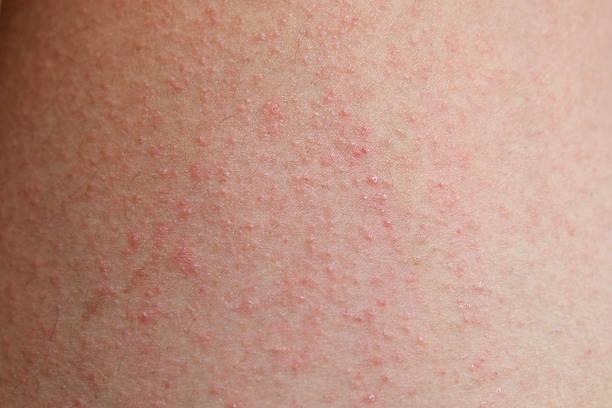 istock allergic rash dermatitis skin of patient 480974310