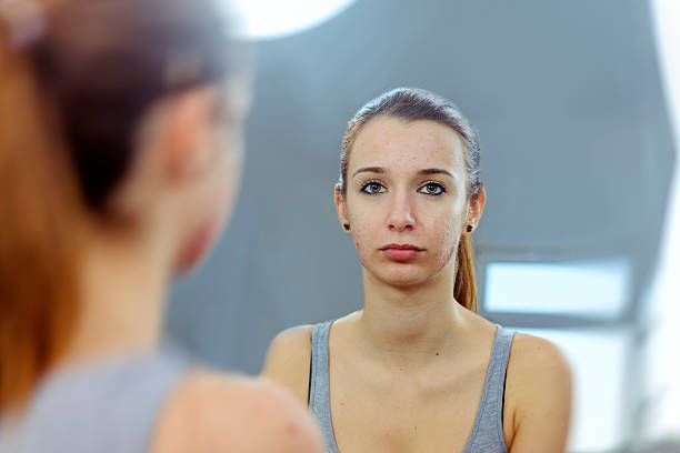 istock teenager portrait with acnee 480982287