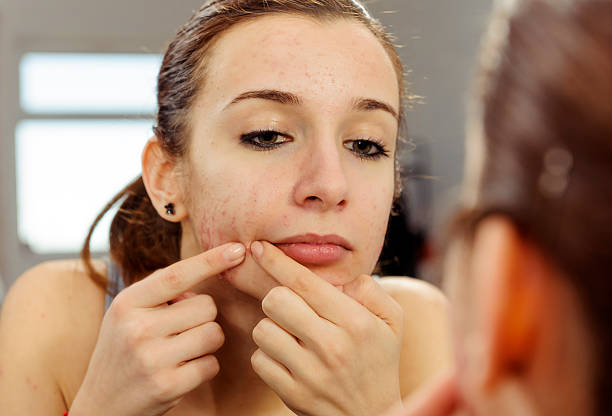 istock teenager with acnee 480982751