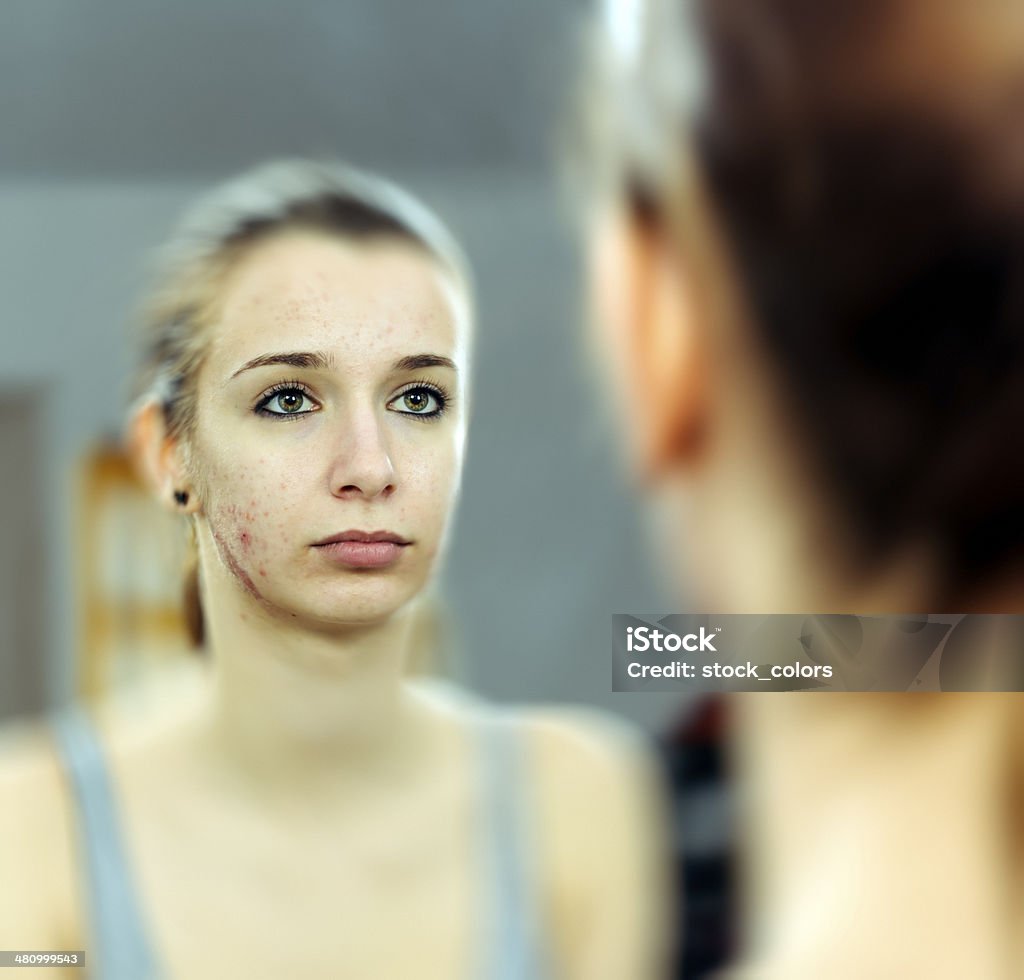 Donna con acnee - Foto stock royalty-free di 16-17 anni