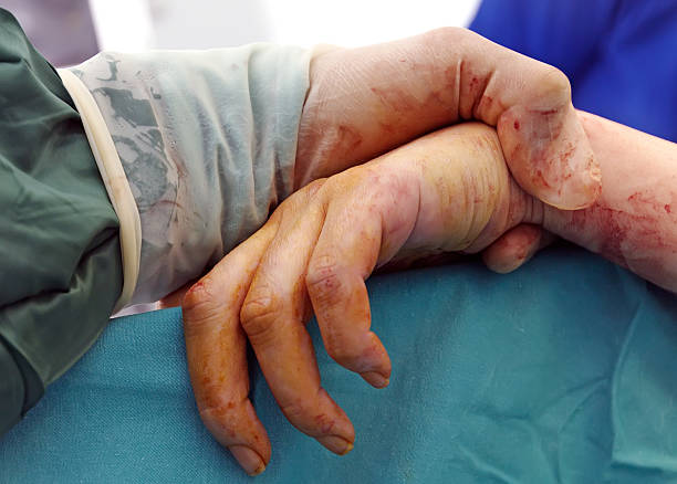 kuvapankkikuvat ja rojaltivapaat kuvat aiheesta elinsiirto - liver transplant