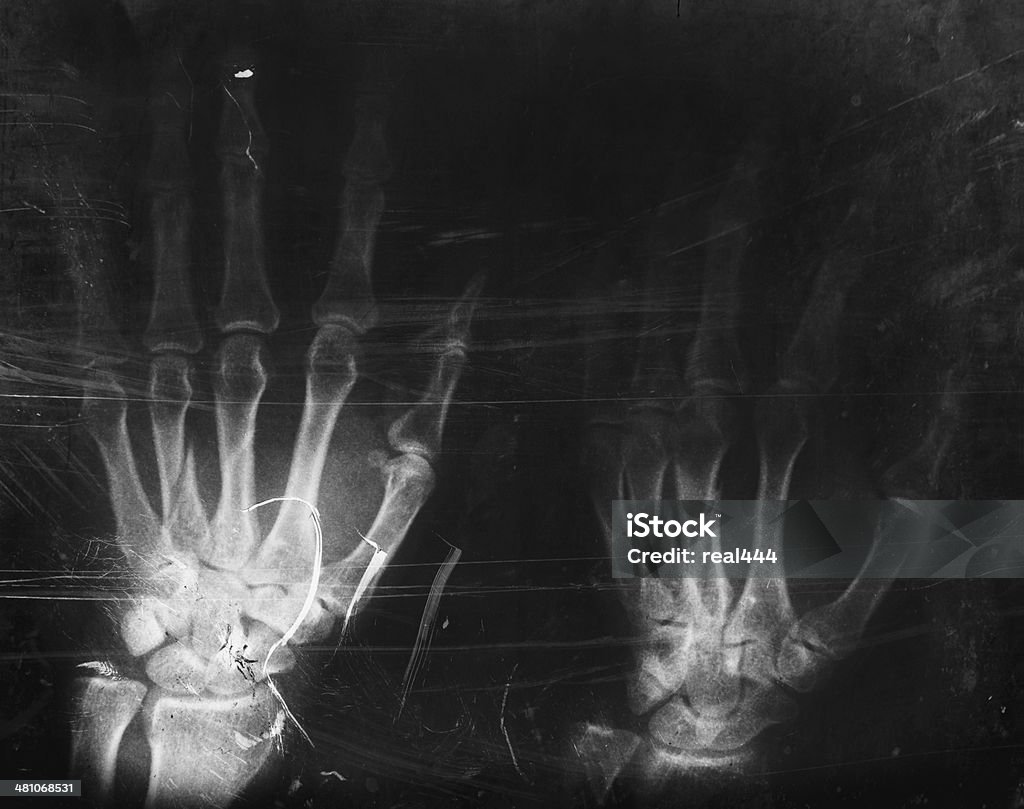 X 線画像の手 - X線撮影のロイヤリティフリーストックフォト