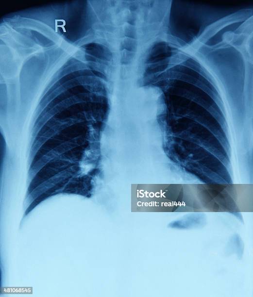 Röntgenbild Der Brust Stockfoto und mehr Bilder von Brustbein - Brustbein, Brustbereich, Brusthöhle