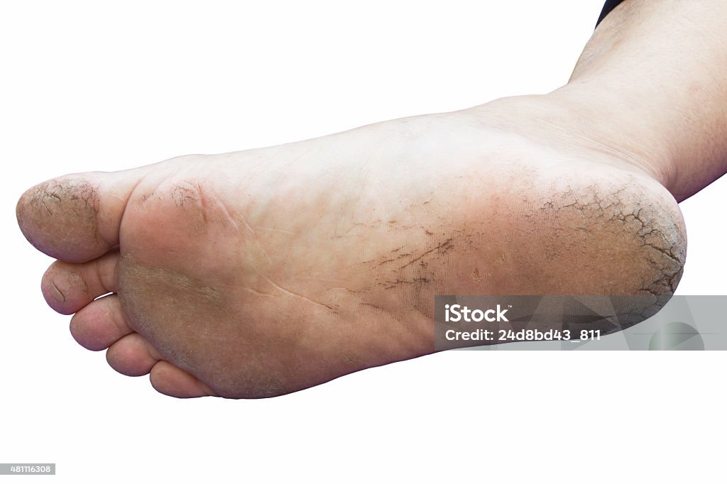 Cracks on Heels Close up of Cracks on Heels isolated white background. 2015 Stock Photo
