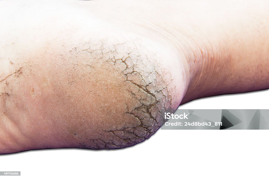 Cracks on Heels Close up of Cracks on Heels isolated white background. 2015 Stock Photo