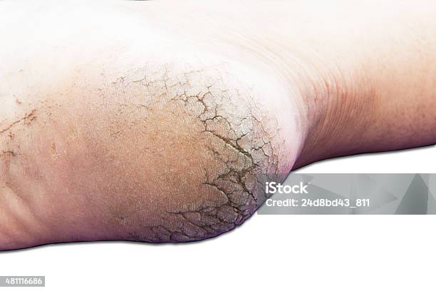 Cracks On Heels Stock Photo - Download Image Now - 2015, Adult, Asia