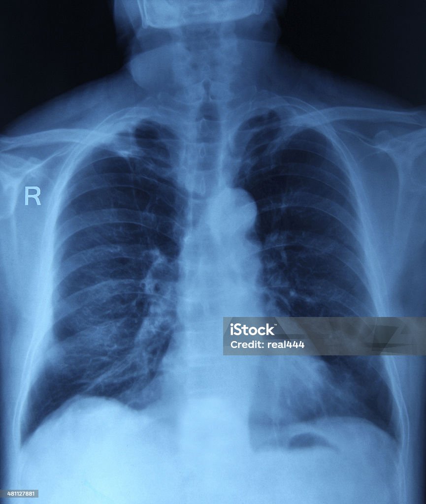 Una radiografía de tórax imagen - Foto de stock de Caja torácica humana libre de derechos