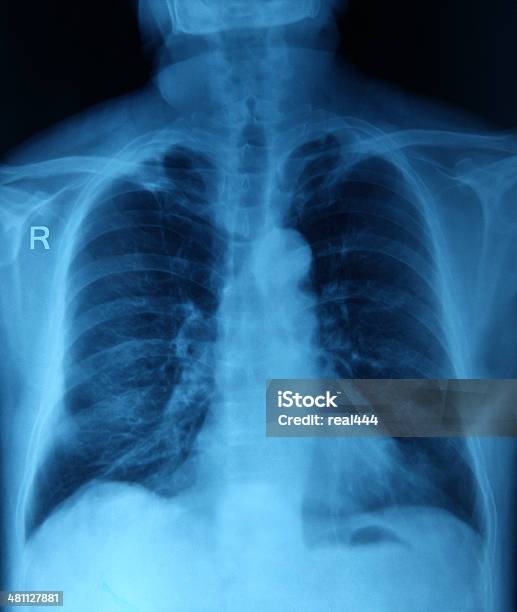 Una Radiografía De Tórax Imagen Foto de stock y más banco de imágenes de Caja torácica humana - Caja torácica humana, Cavidad torácica, Clavícula