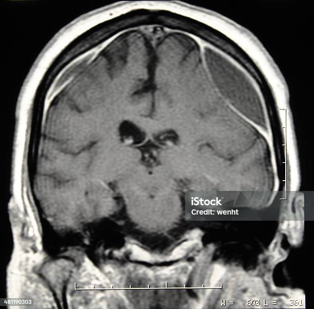 Brain Ct Scan With Subdural Hematoma Stock Photo - Download Image Now - Chronic Illness, Hemorrhage, CAT Scan