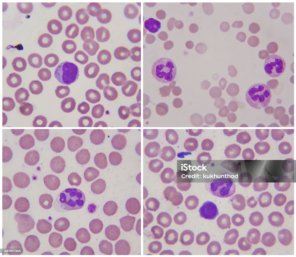 Aml Microscope Slide Leukemia Under Microscope