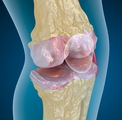 Osteoporosis de la articulación de la rodilla photo