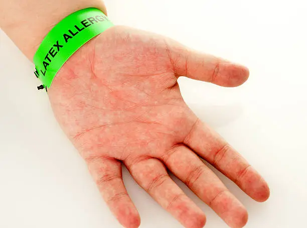 A hand with a latex allergy bracelet around wrist