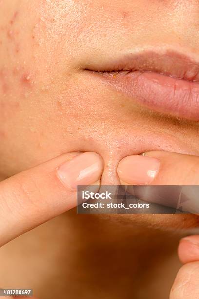 Pimple On Her Face Stock Photo - Download Image Now - 18-19 Years, Abscess, Acne