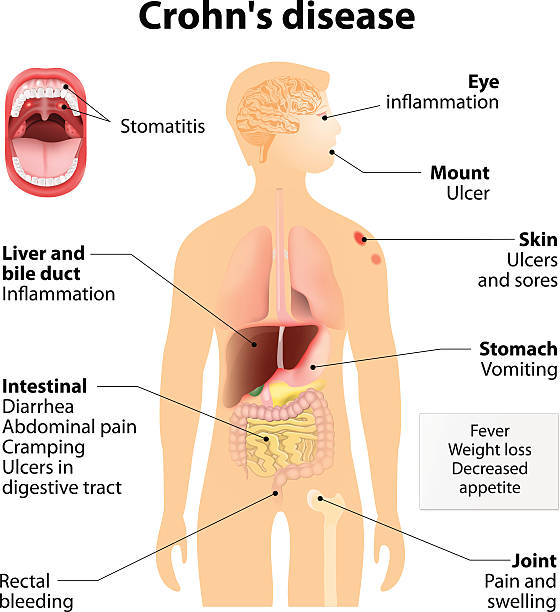 Crohn's disease or Crohn syndrome Crohn's disease or Crohn syndrome and regional enteritis. Signs and symptoms.  Human silhouette with highlighted internal organs colon cancer screening stock illustrations