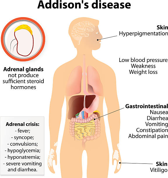 addison choroby - insufficiency stock illustrations