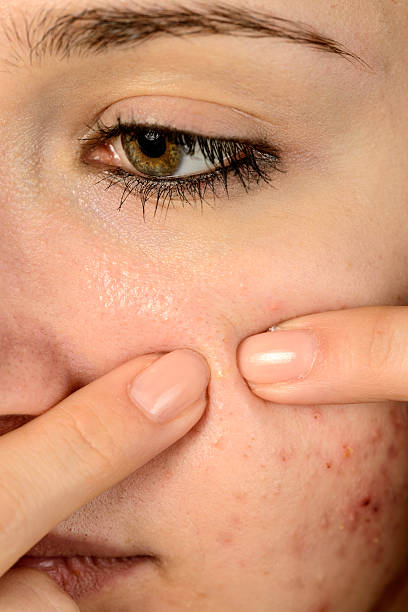 istock remove pimple, macro on teenager face 481332479