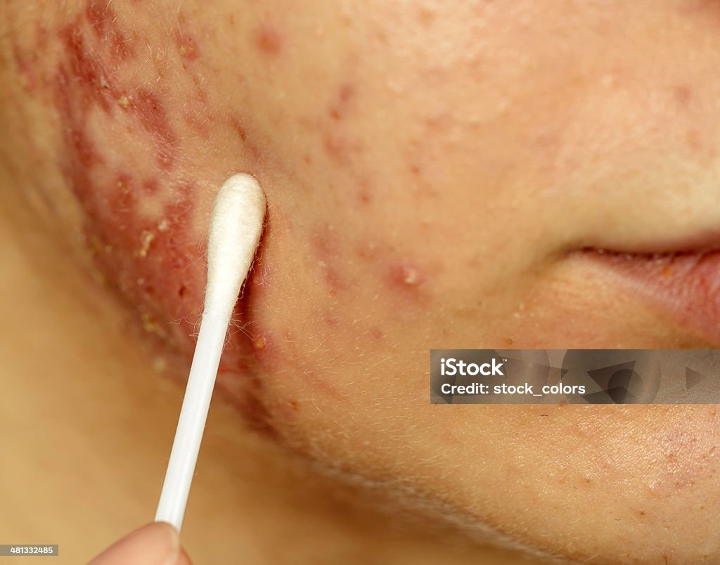 pimple problems macro on woman face removing pimple. Human Face Stock Photo