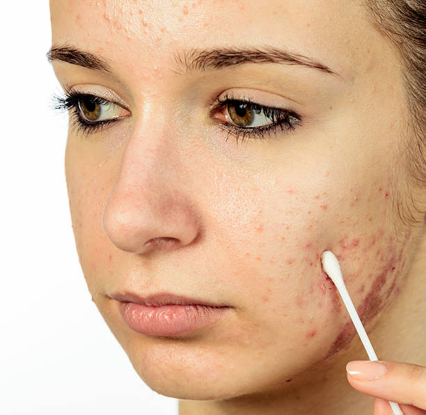 istock woman portrait with acne 481332487