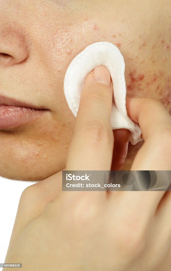 cleaning acne woman portrait cleaning face with disc, macro shot. Acne Stock Photo