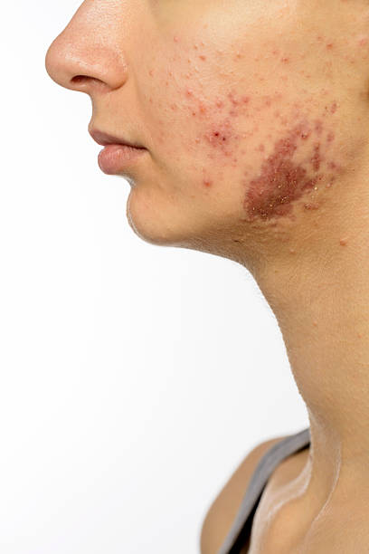 istock acne scar on teenager face 481392799
