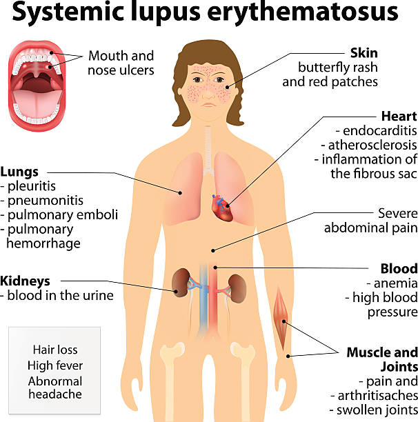 Systemic lupus erythematosu Systemic lupus erythematosu. SLE or lupus, is a systemic autoimmune disease. Symptoms & Signs. Human silhouette with highlighted internal organs anemia diagram stock illustrations