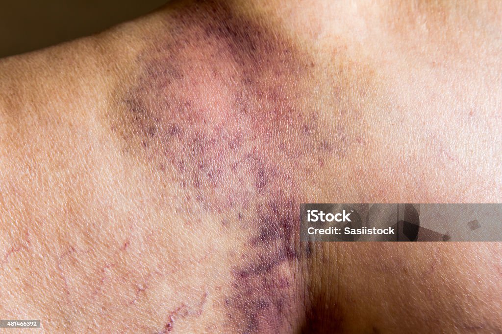 Hematoma en primer plano de una mujer de la piel en las piernas fueran heridos de gravedad - Foto de stock de Cardenal - Lesión física libre de derechos